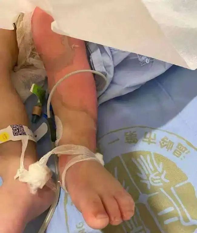 烫伤自救口诀,烫伤急救小常识