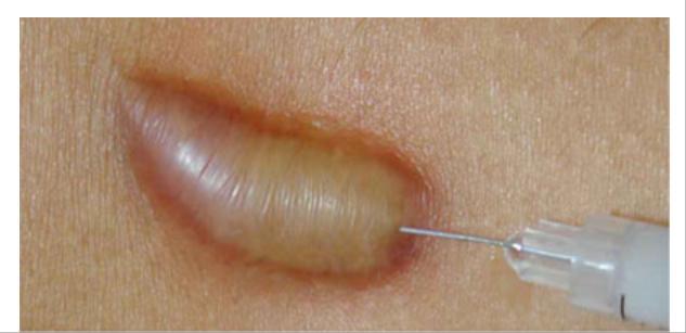 宝宝蚊子叮咬疤痕怎么去除,蚊子叮咬用手抓破后伤好后有疤痕