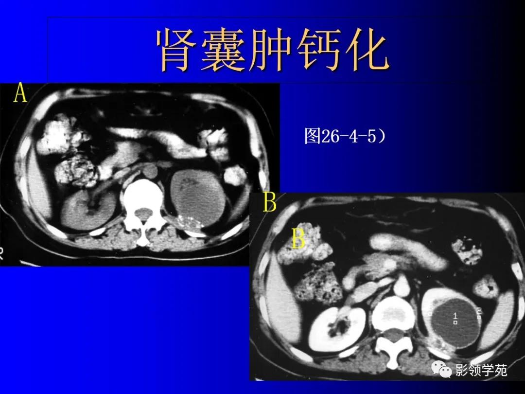肾脏囊性肿块的影像学特点,肾脏典型病理图片及解析