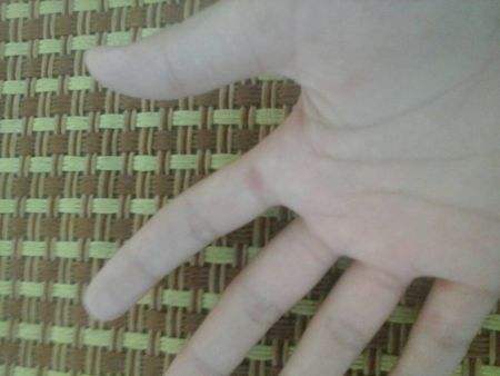 手脚出水泡奇痒难忍教你简单一招,手脚起水泡奇痒无比什么办法最好