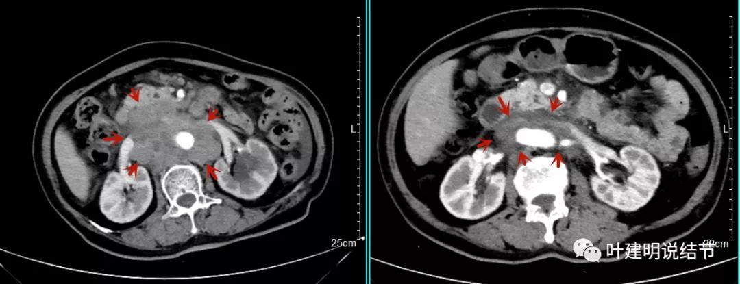 特瑞普利单抗食管癌成功案例,特瑞普利单抗治疗食管癌效果好吗