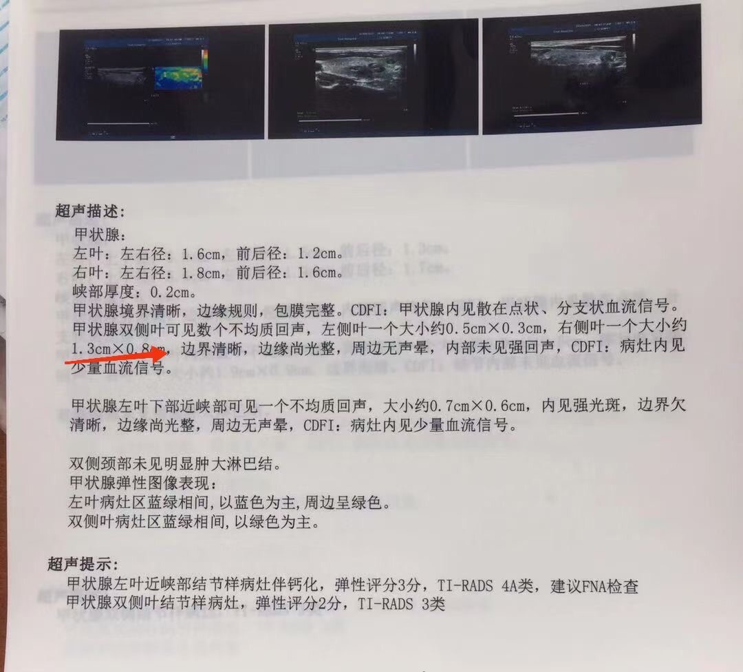 十几岁的小女孩有喉结了怎么办,从小就有喉结会是甲状腺吗