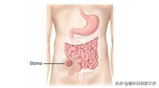 直肠癌手术后出现肛瘘严重吗,直肠癌术后出现肠漏