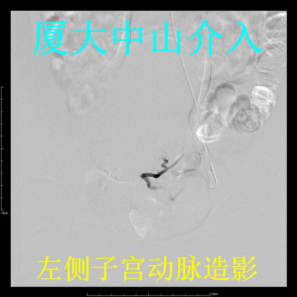 子宫肌瘤介入栓塞对子宫影响,子宫肌瘤介入栓塞的副作用