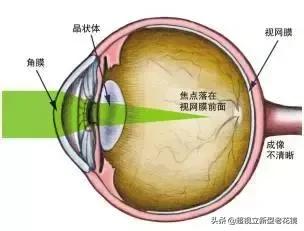 眼球为什么会变长导致近视,眼球为什么会亮