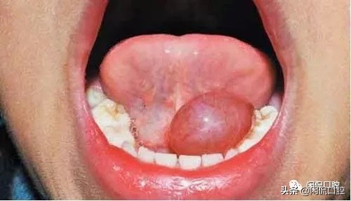 口腔内嘴唇囊肿是什么原因引起的,口腔粘液腺囊肿的原因和治疗方法