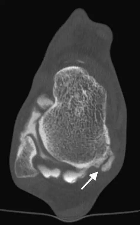 特殊骨折类型,特殊骨折体征