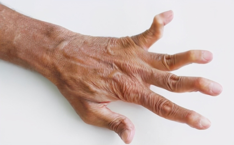 关节疼痛一个药方就能解决,手指关节疼痛弯曲僵硬西药