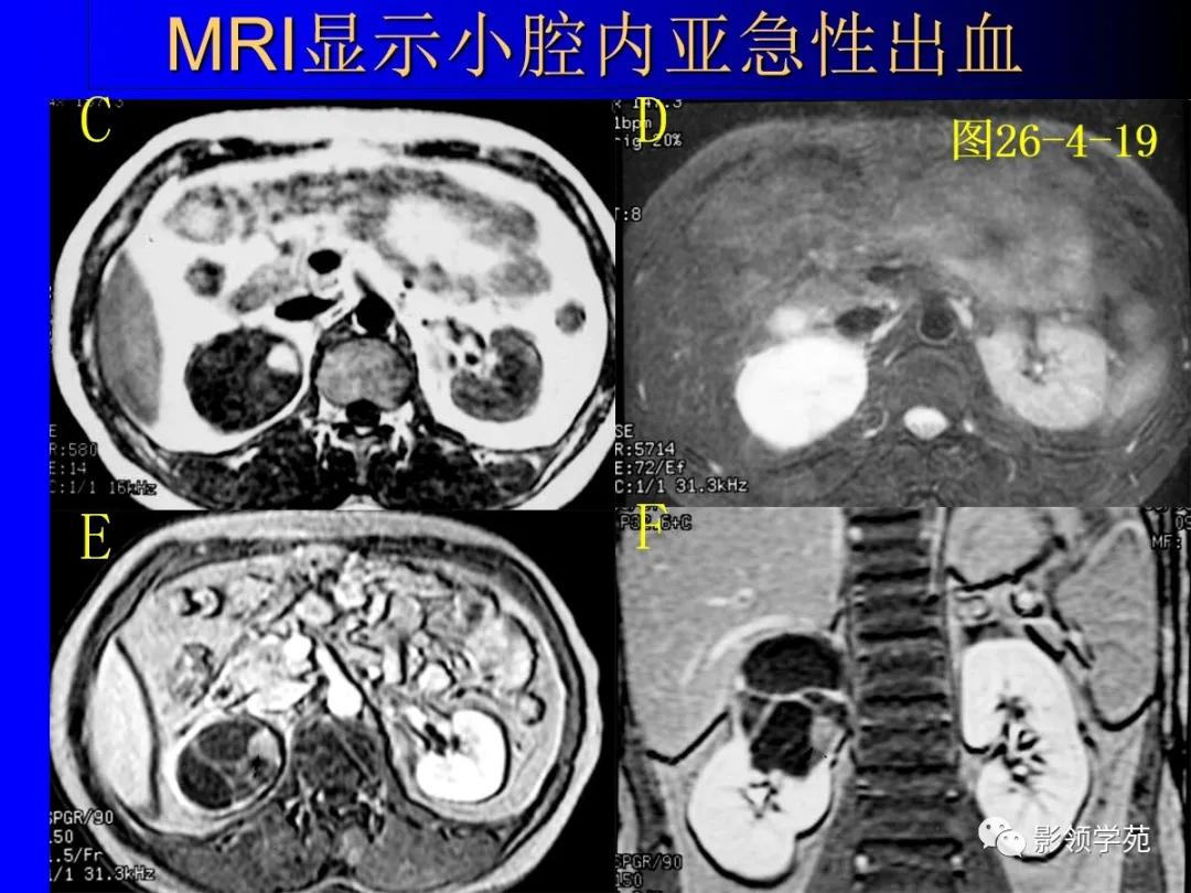 肾脏囊性肿块的影像学特点,肾脏典型病理图片及解析