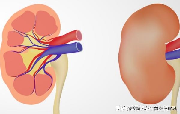 痛风患肾结石的概率高吗,痛风患者患肾结石的几率高吗