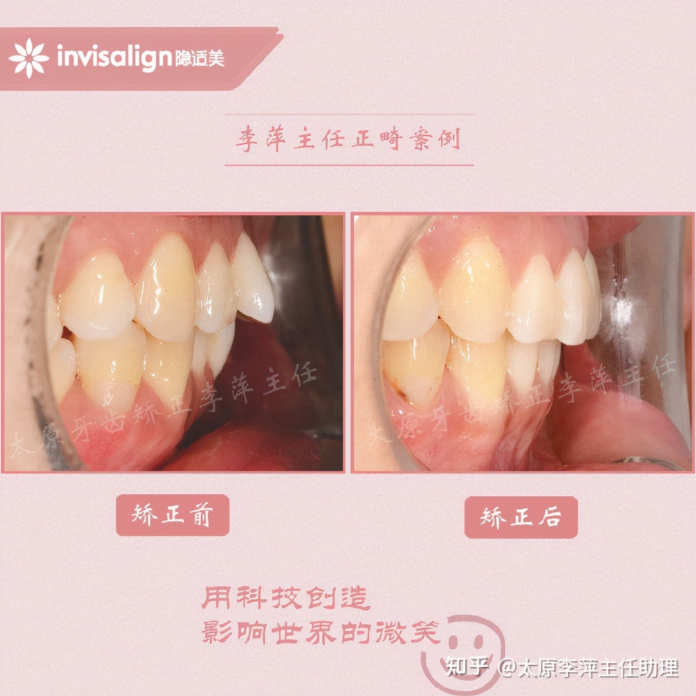 重度拥挤矫正牙齿适合隐形牙套吗,广州成人牙齿矫正推荐隐形牙套