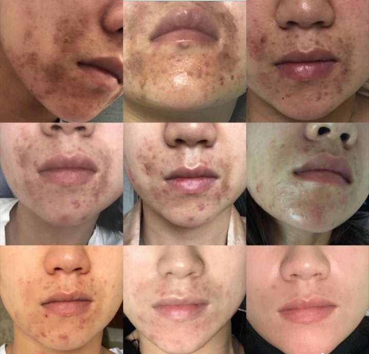 昆明祛除痘印痘坑,如何祛除痘印痘坑效果好