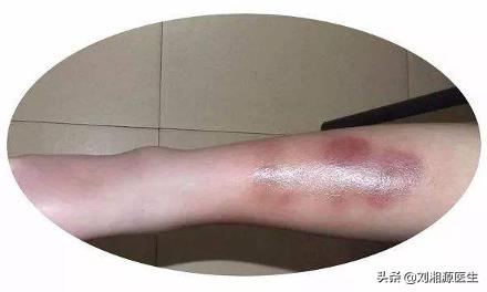 「免疫相关不良妊娠答疑解惑40」——系统性血管炎