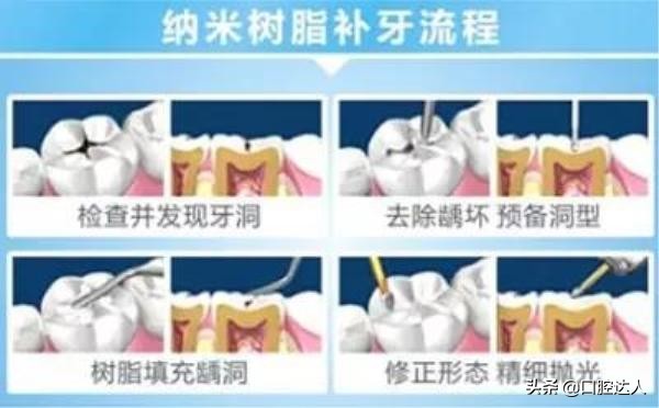 补牙后为什么会牙髓炎,补牙能治好牙痛吗