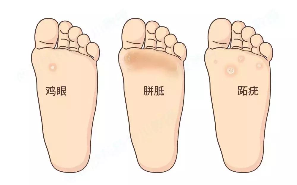 鸡眼和跖疣需要区分！它们的发病原因可不相同