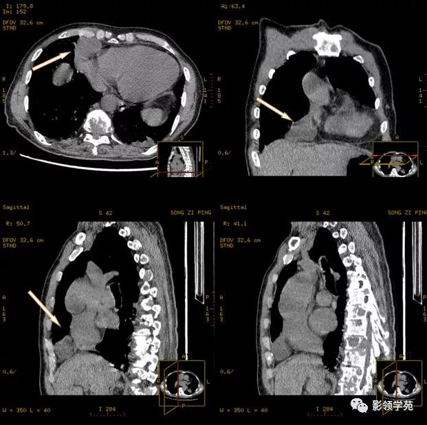纵隔和肾上腺恶性肿瘤,纵隔性肿瘤位置图