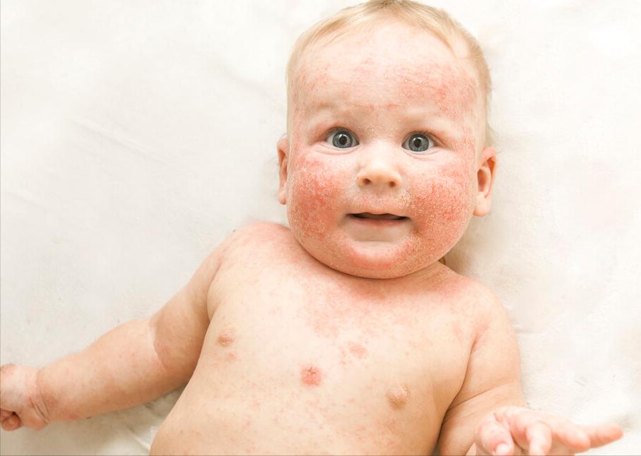 身上有湿疹全身痒得厉害该怎么办,湿疹感染了怎么处理