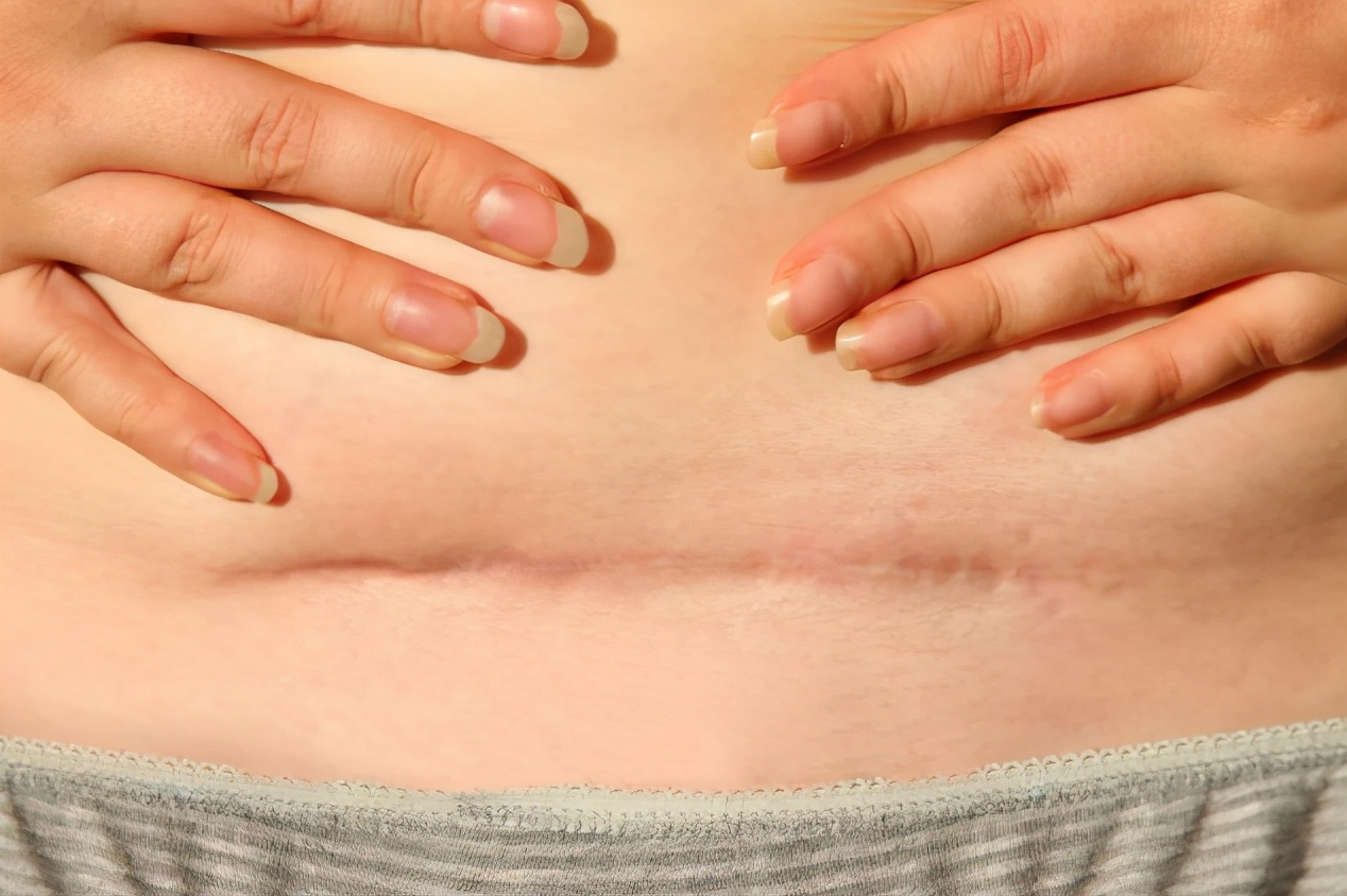 剖宫产瘢痕憩室的发病因素,剖宫产瘢痕憩室是什么