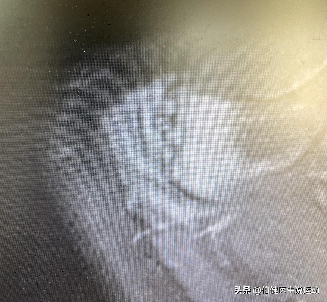 再论肩峰凸起的原因,肩峰凸起是怎么造成的