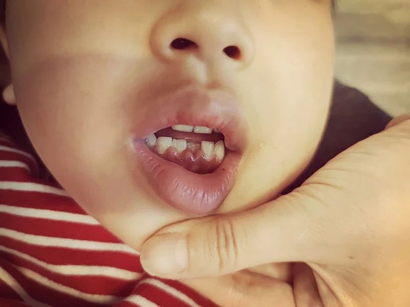 小孩口腔最里面有双排牙,孩子嘴里出了好多牙