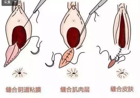 顺产一共要挨多少刀,顺产挨一刀还是侧切