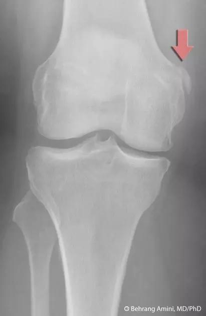 几种严重骨折医学名称,常见的骨折有哪些名称