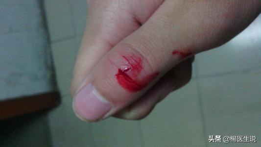 划破手的时候感觉不到痛,划破手流血不容易止住是什么病