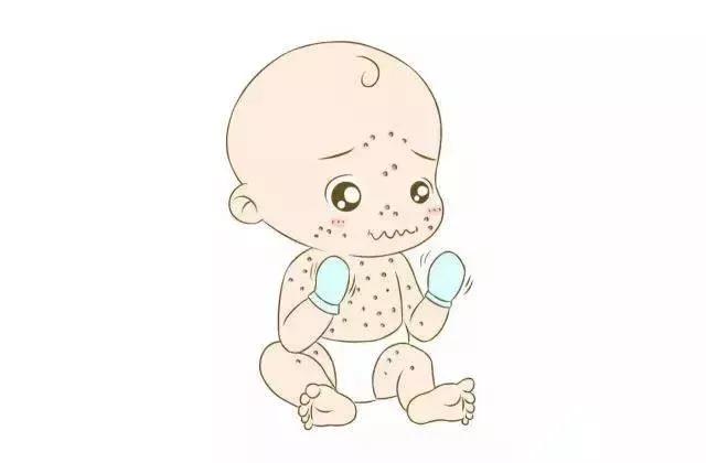 水痘防控知识,健康提示水痘高发准备战痘