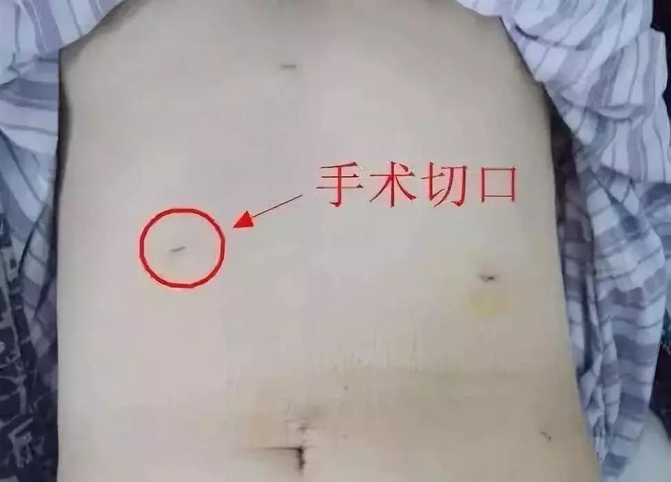 又到农忙季，栖霞的林大哥却因这个坏习惯，得了胃穿孔