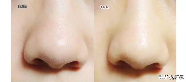 目前有真正去黑头的方法,最近超火的去黑头