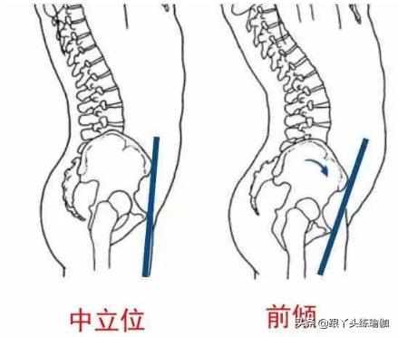 骨盆前倾显臀翘,人看起来是歪的是不是脊柱侧弯