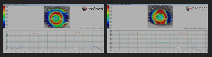 ok镜一周不戴近视更厉害吗,戴了ok镜真的可以恢复视力吗