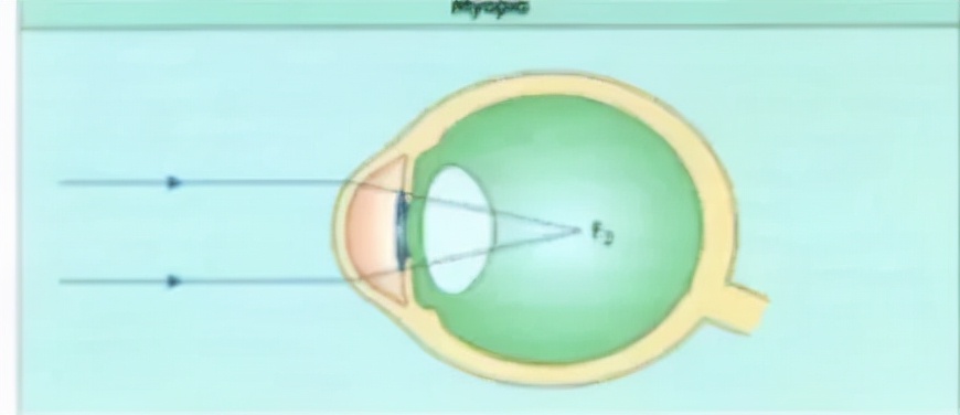 儿童屈光不正配镜专家共识,眼科医生吴夕教授