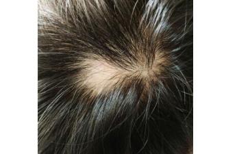 感觉得了很多年狼疮反应变得很慢,得了狼疮真的只能活5-10年吗