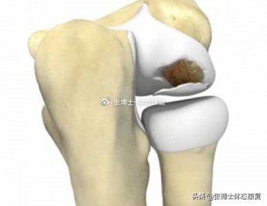 运动肘关节常见创伤及治疗方法,怎么预防肘关节康复二次损伤