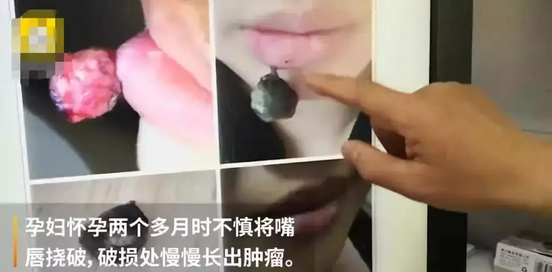 怀孕晚期嘴唇上得了血管瘤怎么办,孕妇嘴唇长血管瘤怎么办