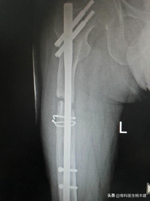 股骨骨折钢板断裂原因分析,骨折钢板在什么情况下容易断裂