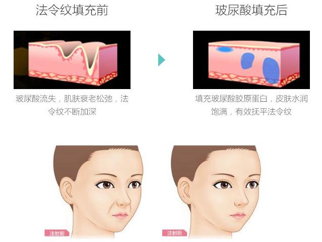 三招改善法令纹,一招就可以把你的法令纹淡下去