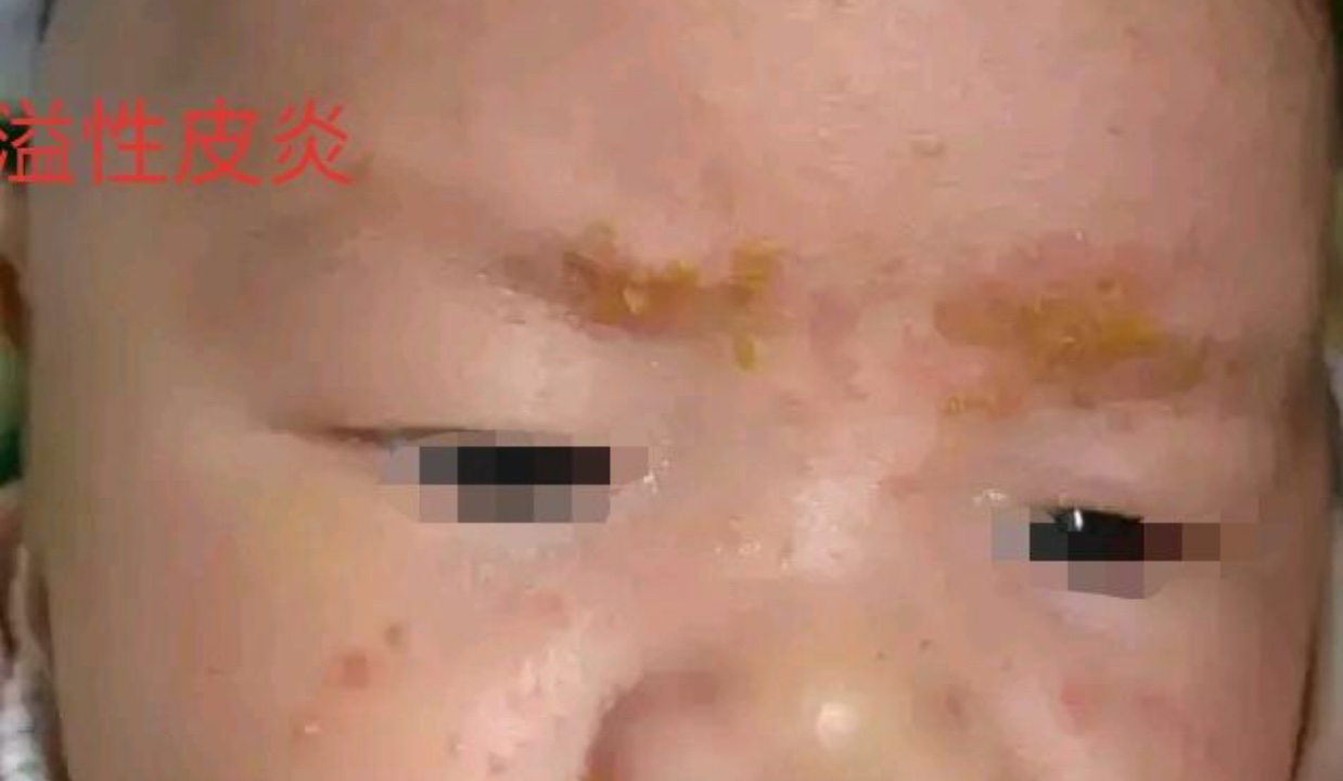 宝宝脂溢性湿疹可以涂什么药膏,宝宝湿疹脂溢性皮炎