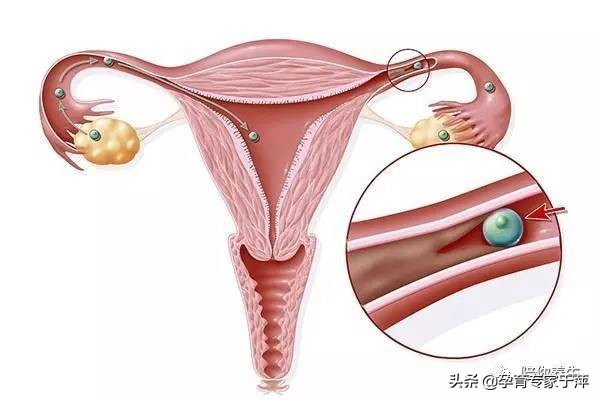 青岛助孕专家于萍:输卵管造影,常见问题解答