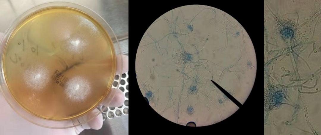 病例分享：无计可施时「黑色的」胸腔积液使治疗找到了方向