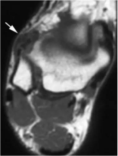 踝关节撞击症问诊,踝关节撞击综合征的x线表现
