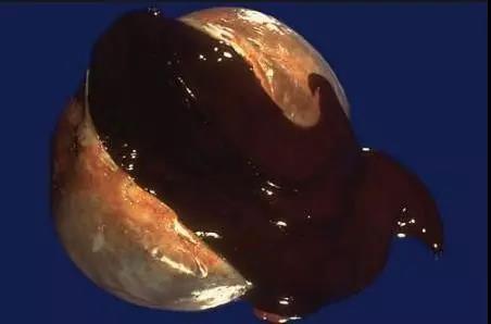 妇产科死亡率最高的癌,妇产科医生谈良性癌症