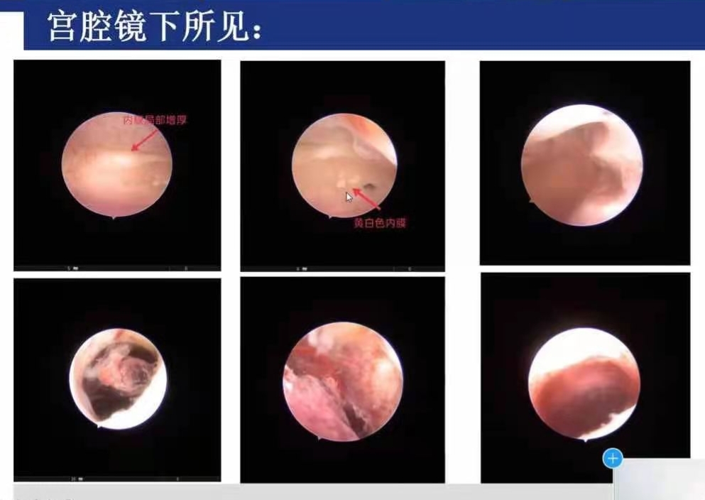 子宫内膜增厚该做什么检查？