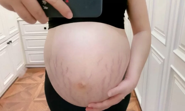 十大祛妊娠纹产品排行榜,妊娠纹产品哪个效果好