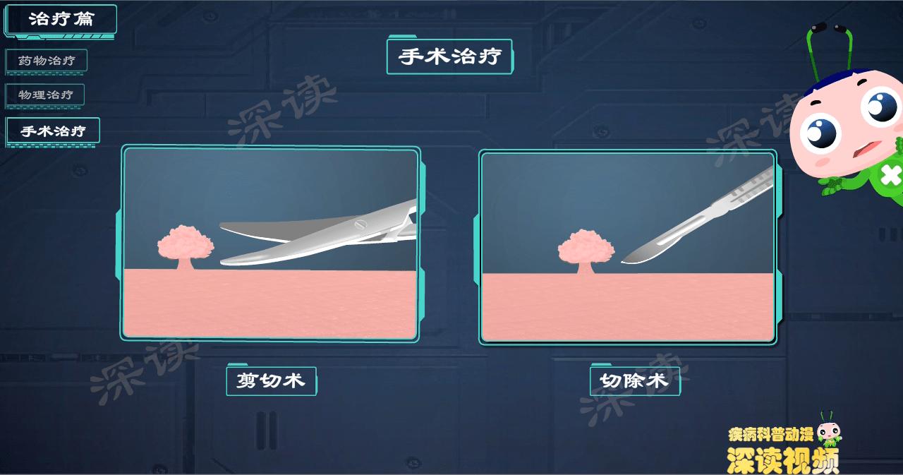 液氮冷冻治疗尖锐疣疼吗 (液氮冷冻治疗尖锐疣几天掉)