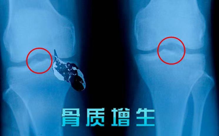 常年膝关节病治疗无果，骨科林医生分析下肢力线施以矫形鞋