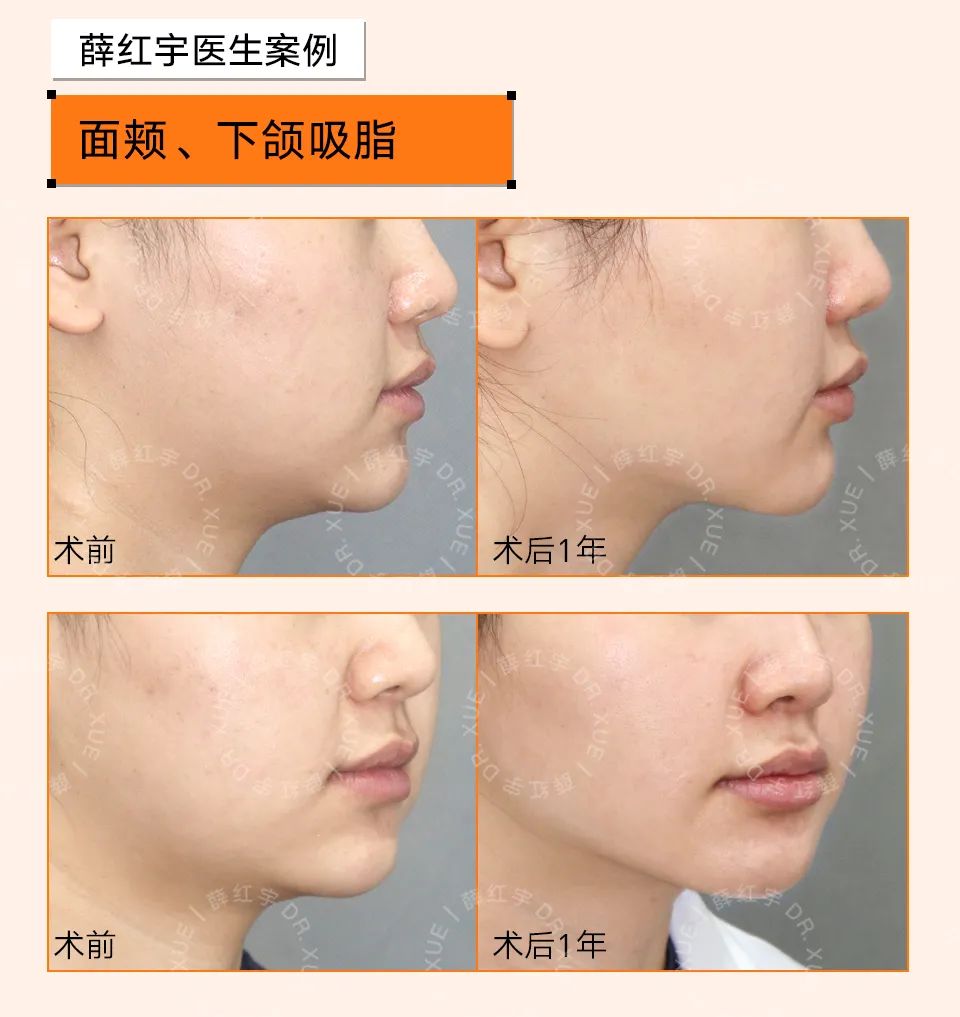 让下颚越来越清晰,下颌缘不清晰的原因