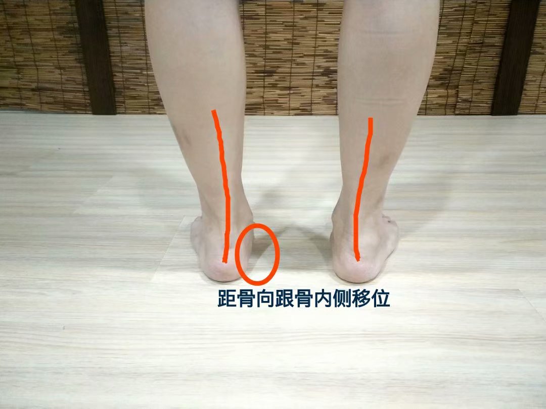 大脚趾外翻怎么锻炼恢复正常,大脚趾外翻矫正危害