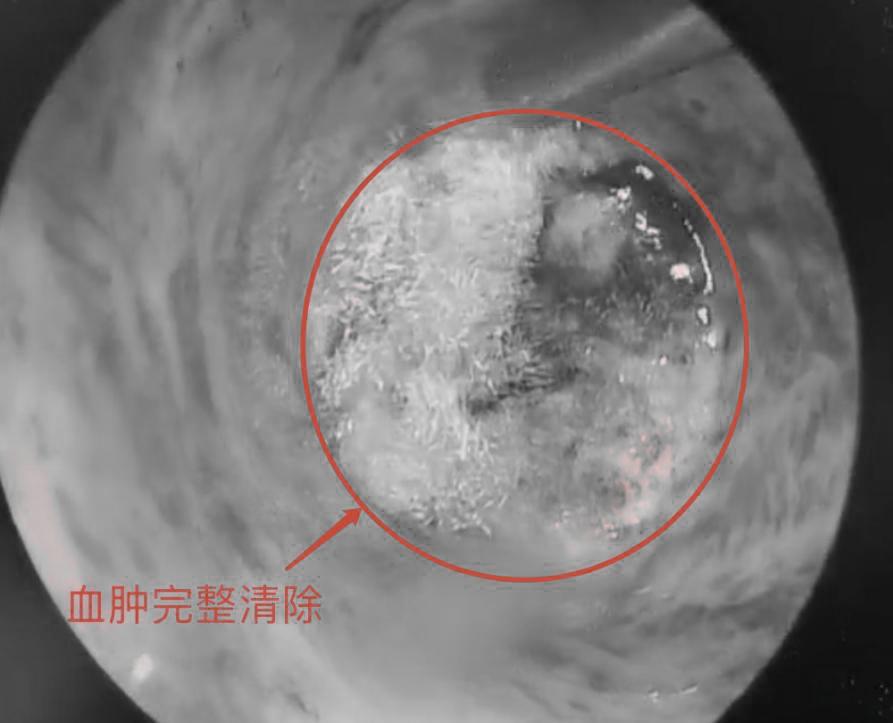 35岁高血压突然脑出血,32岁小伙高血压突发脑出血